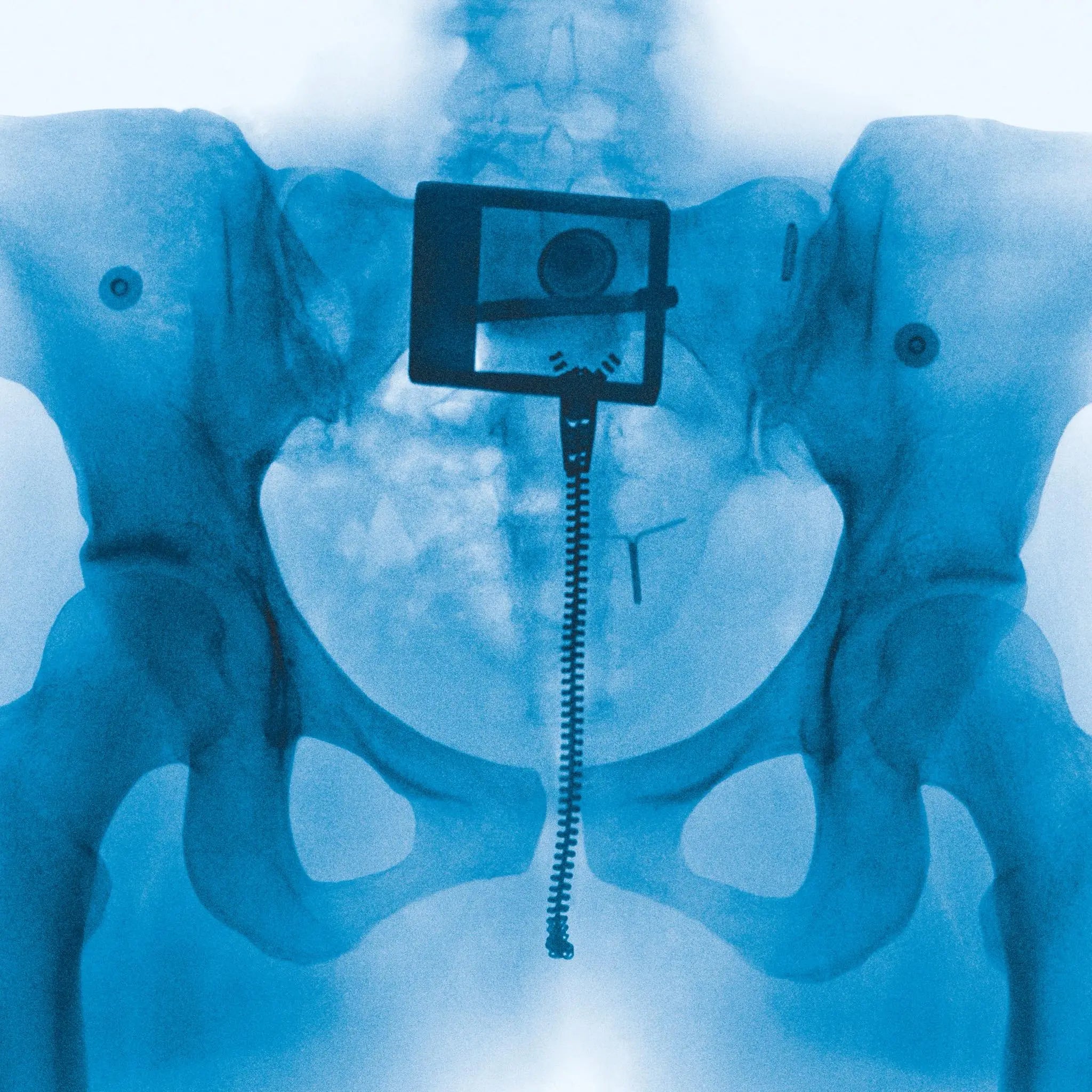 An X-ray image of a pelvis with a zipper and an IUD visible.